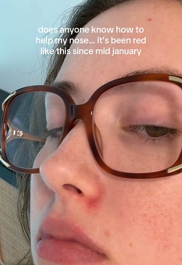 any suggestions for my red dry nostrils 😔 #dermatologist #eczema | Dry Nose