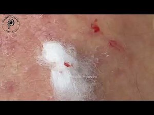 Crazy Satisfying Cheek Acne Extraction That Will Shock You