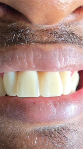 🦷 How to Keep Your Dentures Strong & Long-Lasting 🦷 Dentures can last many years if they are well cared for. Here are simple but important tips to help your dentures stay comfortable, clean, and durable: ✅ Clean daily – Brush your dentures every day using a soft brush and mild denture cleanser. Avoid ordinary toothpaste as it can scratch them. ✅ Remove at night – Give your gums time to rest. Soak your dentures overnight in clean water or denture solution. ✅ Handle with care – Dentures can brea