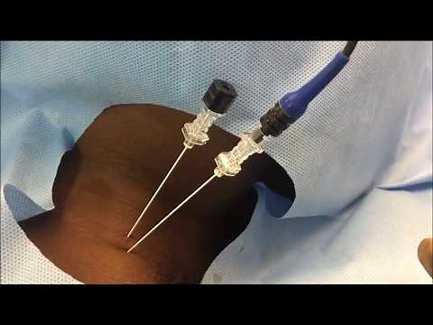 Cervical 3rd occipital nerve and medial branch radiofrequency ablation
