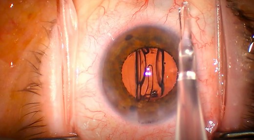 Tecnis Eyhance IOL Insertion - Eyetube