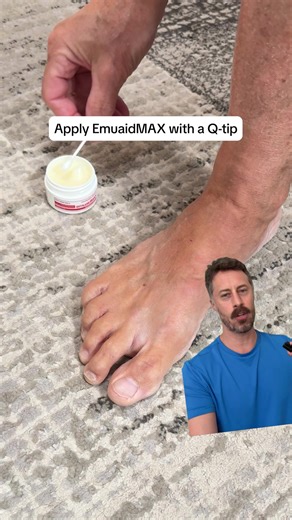 Stubborn nail fungus? 😣🦠 When nothing else worked, EMUAIDMAX® delivered. "After 3 years of trying many other methods, I finally found a cure with Emuaidmax. I immediately saw results from the first application. Totally amazing fungus was stopped in its tracks. Watched the nail grow back clear over a 6 - 8 month period. Thank you Emuaid!" | Emuaid