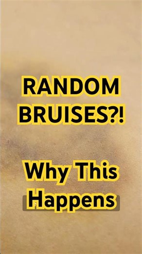 Bruises Out of NOWHERE?! Here’s What Your Body’s Telling You #healthtips #facts #health