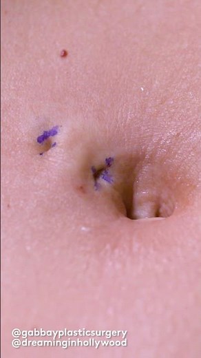 How Belly Button Piercing Removal Actually Works #shorts