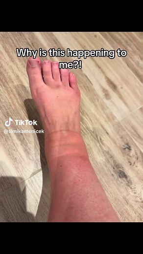Understanding Insect Bites and Swollen Ankles