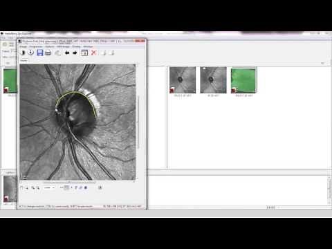 Case Study with SPECTRALIS OCT: Glaucoma