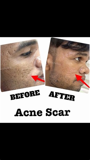 Acne Scar Treatment | acne scar laser treatment | acne scar cream | how to remove acne scars