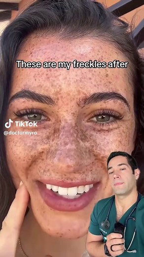 Doctor Explains Freckle Skincare Tips