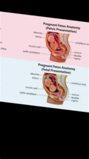 🤰 PELVIC vs FETAL PRESENTATION 👶✨ 🦴 PELVIC PRESENTATION ➡️ Refers to how the baby is positioned in the mother’s pelvis 📍 Focuses on which part of the baby enters the birth canal ✅ Important for planning safe delivery 👶 FETAL PRESENTATION ➡️ Describes the part of the baby facing the cervix 📍 Examples: • 👶 Cephalic – head first (most common) • 🍑 Breech – buttocks or feet first • ➖ Shoulder/Transverse – shoulder first 🩺 Why It Matters ✔️ Helps doctors decide the safest way to deliver ✔️ Af