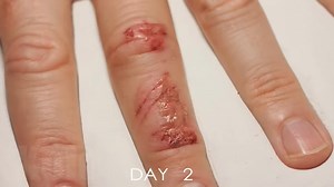 Wound healing time lapse