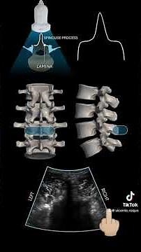 Lumbar Medial Branch Injection