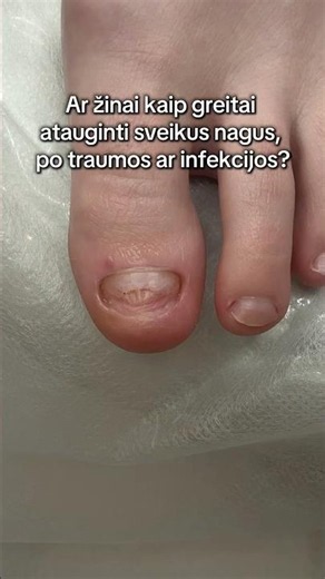Kaip greitai atauginti sveikus nagus, po traumos ar infekcijos?