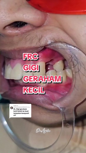Apa Itu Fiber Reinforced Composite (FRC)? Penjagaan, Ketahanan, dan Kelebihannya