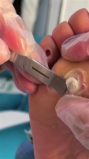 Effective Plantar Wart Removal Techniques