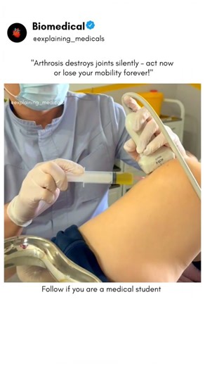 BIOMEDICAL | Follow @explaining_medicals ⬇️⬇️⬇️⬇️ What text books can't show you, We animate. Arthrosis (Osteoarthritis) is a chronic degenerative... | Instagram