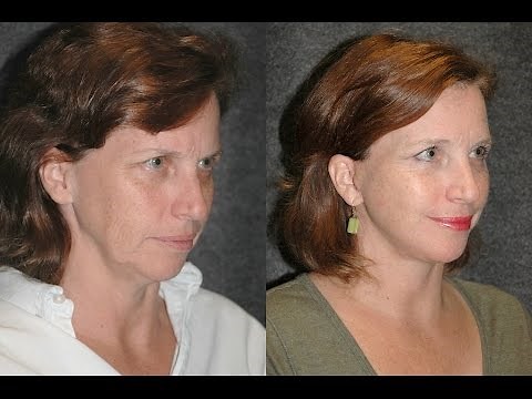 Mini Facelift Before and After on 51 Year Old Woman | Dr Andrew Jacono Reviews #mini-facelift