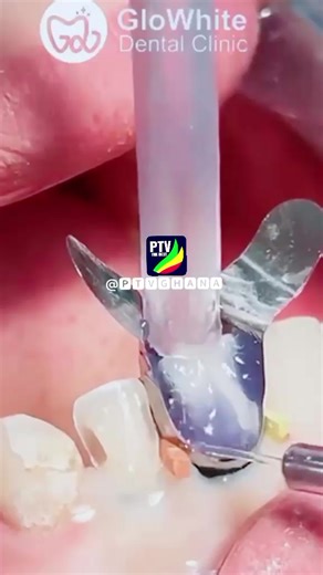 How to Achieve Clean Teeth at Home