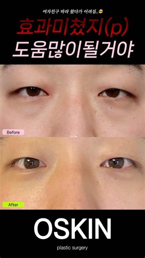 오스킨 설날 눈밑지 수술 예약 풀인 이유? #shorts #눈밑지방재배치