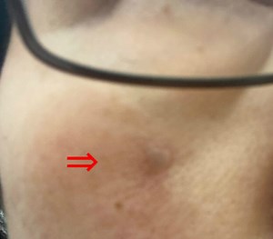 【シミ（イボ）取り】１４日間の経過公開！ビフォーアフターとかかった費用 | Rinのシンプルライフ