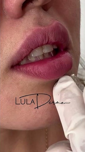 AUMENTO DE LABIOS CON ÁCIDO HIALURONICO