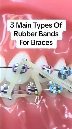 3 Main Types of Rubber Bands for Braces. #braces #rubberbands #bracestips #orthodontics