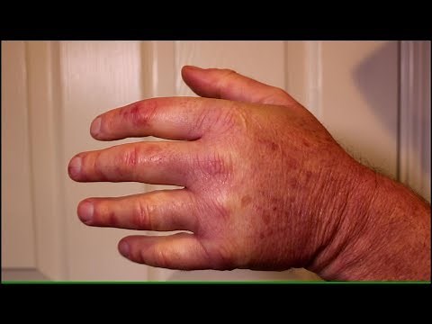 My Swollen Fingers and Hands from TOS