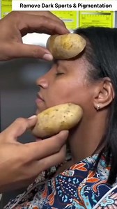 1.3M views · 4.2K reactions | Easy Potato Facial To Remove Dark Sports & Pigmentation | Get Clear Glowing Skin #pigmentation #glowingskin #darkspots #SpotlessSkin #Skincare #reelsfb #virals | Health Beauty Treat | Facebook