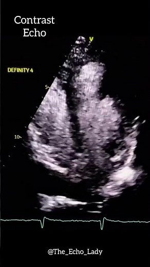 Apical Aneurysm💙🫣 #anatomy #doctor #hearttest #medicine #echocardiogram #heartscan #Aneurysm