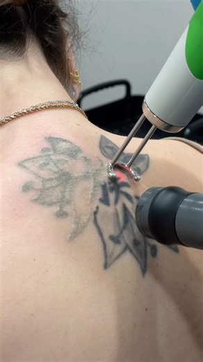 First Session Laser Tattoo Removal / BACK Tattoo ASMR #lasertattooremoval #tattooremoval #asmr #pov