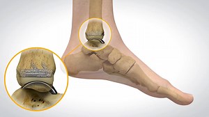 Ankle arthritis comes with: ⚫ Pain ⚫ Reduced ability to walk ⚫ Reduced ability to stand for long periods ⚫ Stiffness ⚫ Swelling Surgery may be recommended. But a fusion stops the ankle from moving, which can be hard to face. There is another option! With Stryker’s Total Ankle Replacements, the ankle can keep more of its ability to move and rotate. Stryker’s Total Ankle Replacements can: ⚫ Address the pain. ⚫ Maintain an active lifestyle. ⚫ Helps patients continue to walk normally. Stryker’s Tota