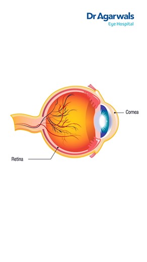 1.3K views · 12 reactions | Understanding refractive procedures is...