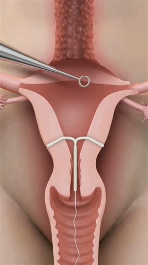 IUD Procedure: How the Insertion Actually Works 3D Animation #iudinsertion #iud #anatomy