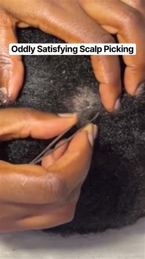 ASMR Flaky Scalp Nitpicking + Scratching 😴 || Tweezers #asmrnitpicking #asmrsounds #asmrhairplay