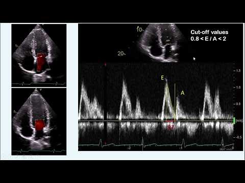 diastolic dysfunction part I - concept & measurement