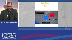 Cases with Complications and Bailouts: DVT