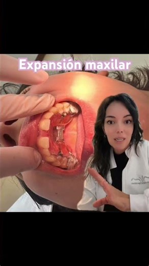 Maxillary expansion with orthopedics