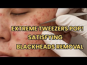 Skincare | Extreme Forehead Acne Extraction ASMR | Satisfying Blackheads Removal Tweezers