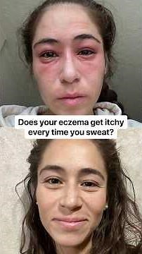 Does your eczema get itchy every time you sweat?