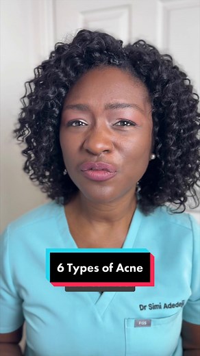 6 Types of Acne Spots. Which one(s) do you have?? 1. Blackheads 2. Whiteheads 3. Papules 4. Pustules 5. Nodules 6. Cysts Disclaimer: Not medical advice, for educational purposes only. Youtube.com/DrSimiAdedeji #acne #acne #skinacne #skin #skinhealth #acnespot #acnespots #acneskin #acneproneskin #acneeducation #blackheads #pimplesandblackheads #whiteheads #papulesacne #papules #pustules #nodules #nodules #cysticacne #cyst #cysts