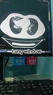 CT chest ||Lung window #ctscan #lungs #anatomy #radiographer
