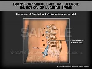 Transforaminal Epidural Steroid Injection of Lumbar Spine