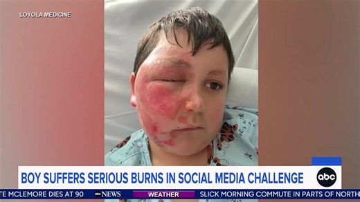 BOY SUFFERS BURNS IN SOCIAL MEDIA CHALLENGE: The 9-year-old and his mom are now talking about the popular trend, offering a big warning to kids and parents. ABC’s Reena Roy reports. | World News Now