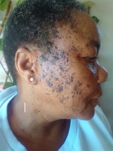 Effective Skin Tag Removal Process Explained