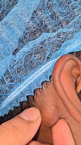 Post auricular fibrolipoma | Gazelle2712