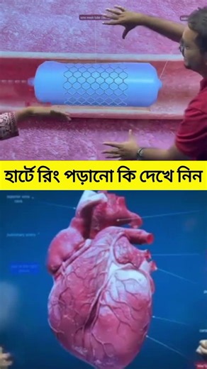 Want to see how a stent is placed in the heart? #HeartAttackEmergency #CPRTraining #HeartAttack #...