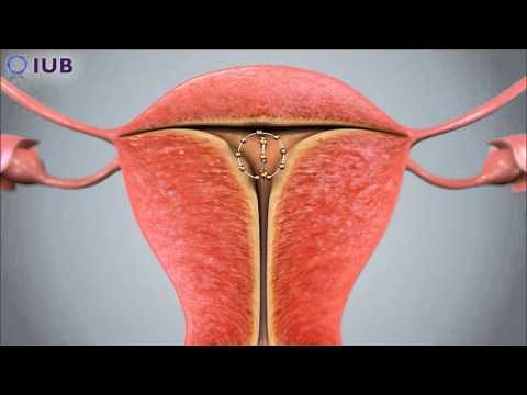 IUB SCu300 spherical IUD insertion procedure
