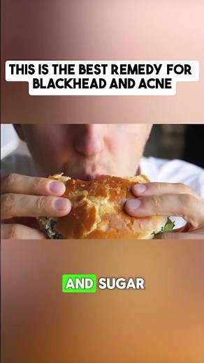 The BEST BLACKHEAD & Acne Remedy