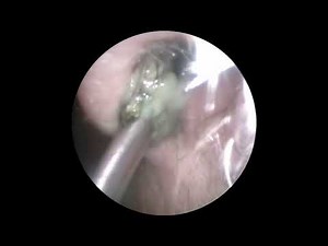 Booger removal | How to remove deep boogers (what not to do) ?