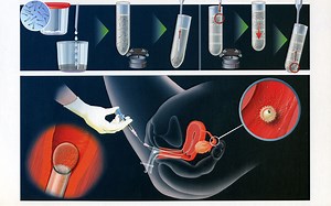 Intrauterine Insemination