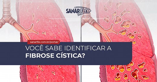 Fibrose Cística: sintomas, diagnóstico e tratamento